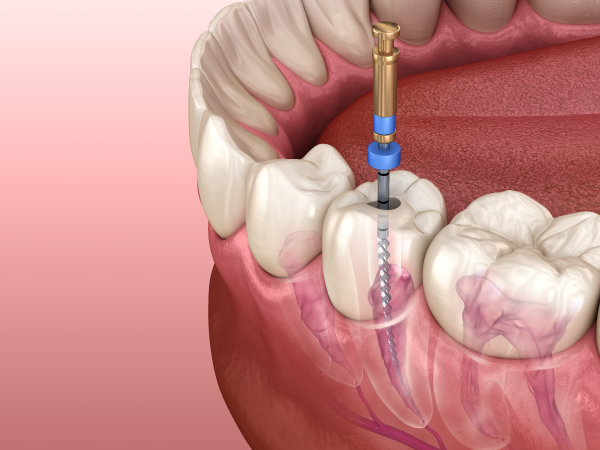 endodoncia-02