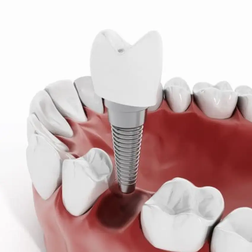 plasma-rico-en-plaquetas-en-implantes-dentales-ilustracion