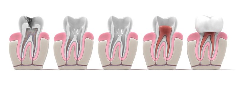 3d renderings of endodontics - root canal procedure