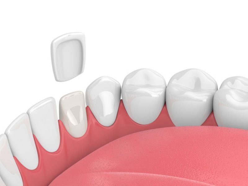 3d render of teeth with veneer