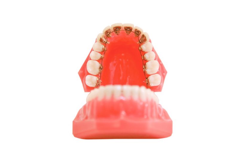 appareil dentier