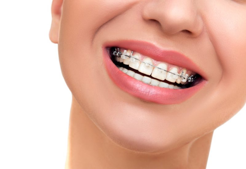 Closeup Beautiful Female Smile with Ceramic and Braces on Teeth.